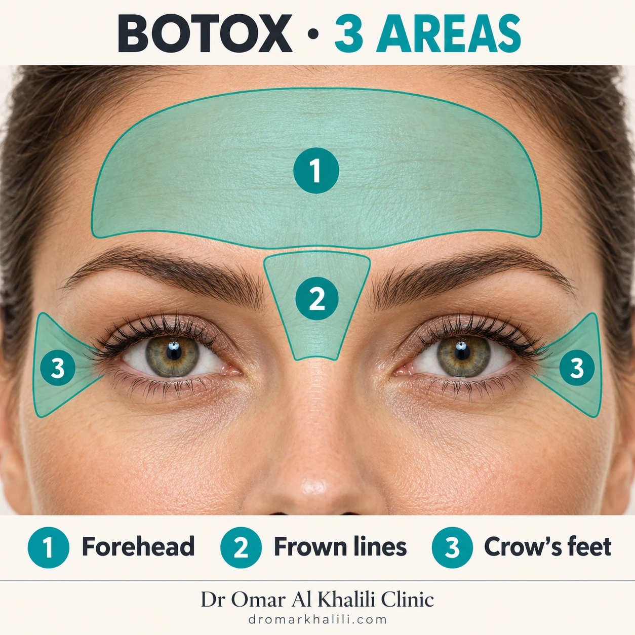 Botox three-area treatment showing the forehead, frown lines, and crow’s feet at Dr Omar Al Khalili Clinic in Dubai