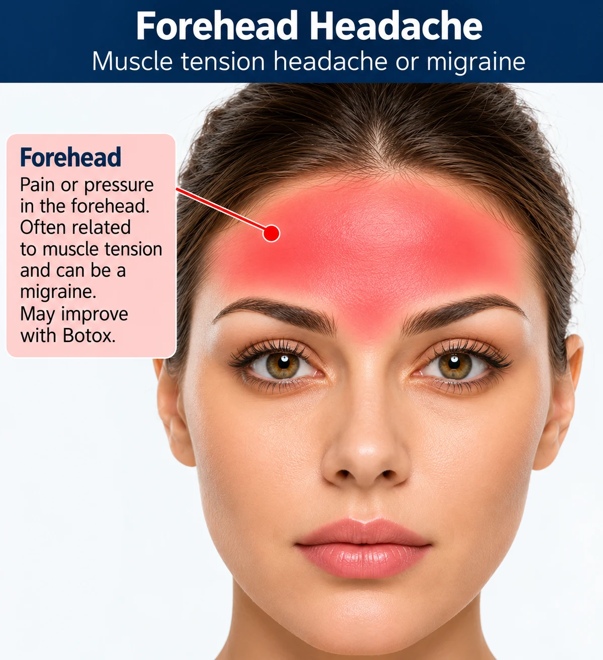 Educational illustration of forehead pressure and muscle tension headache or migraine symptoms
