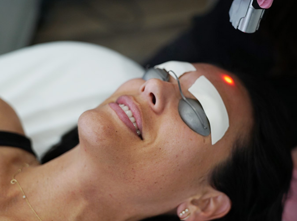 Microneedling Salmon DNA
