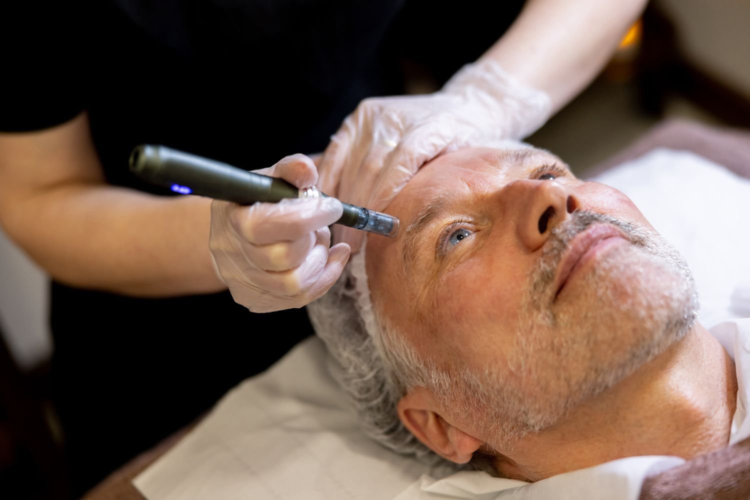 Microneedling Salmon DNA