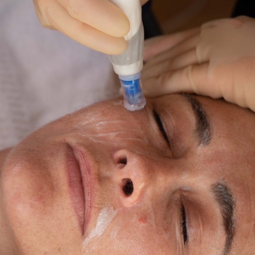 Microneedling Salmon DNA