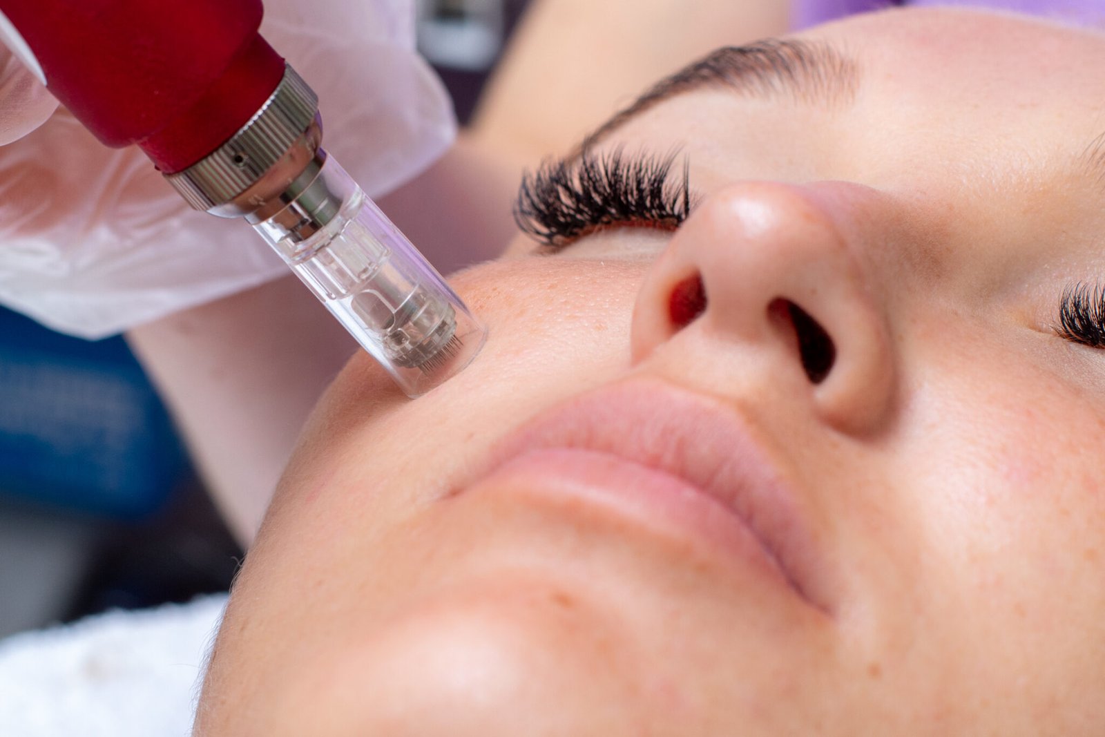 Microneedling Salmon DNA